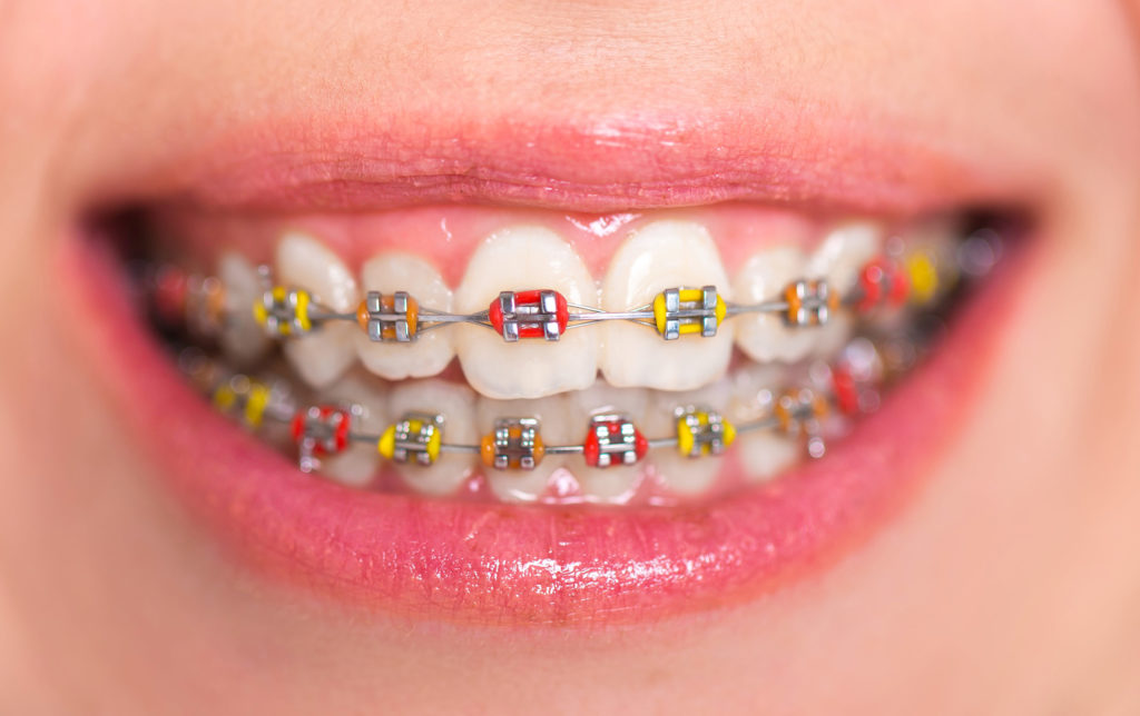 Getting Colored Braces in Texas